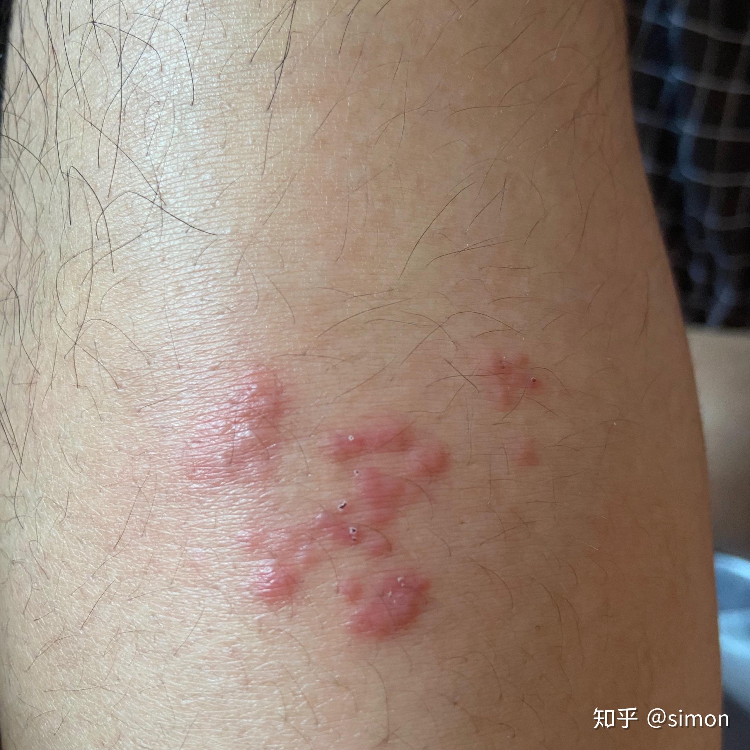 手肘和膝盖突然长出很多坨痒怎么回事就是几秒之内发现很痒然后迅速