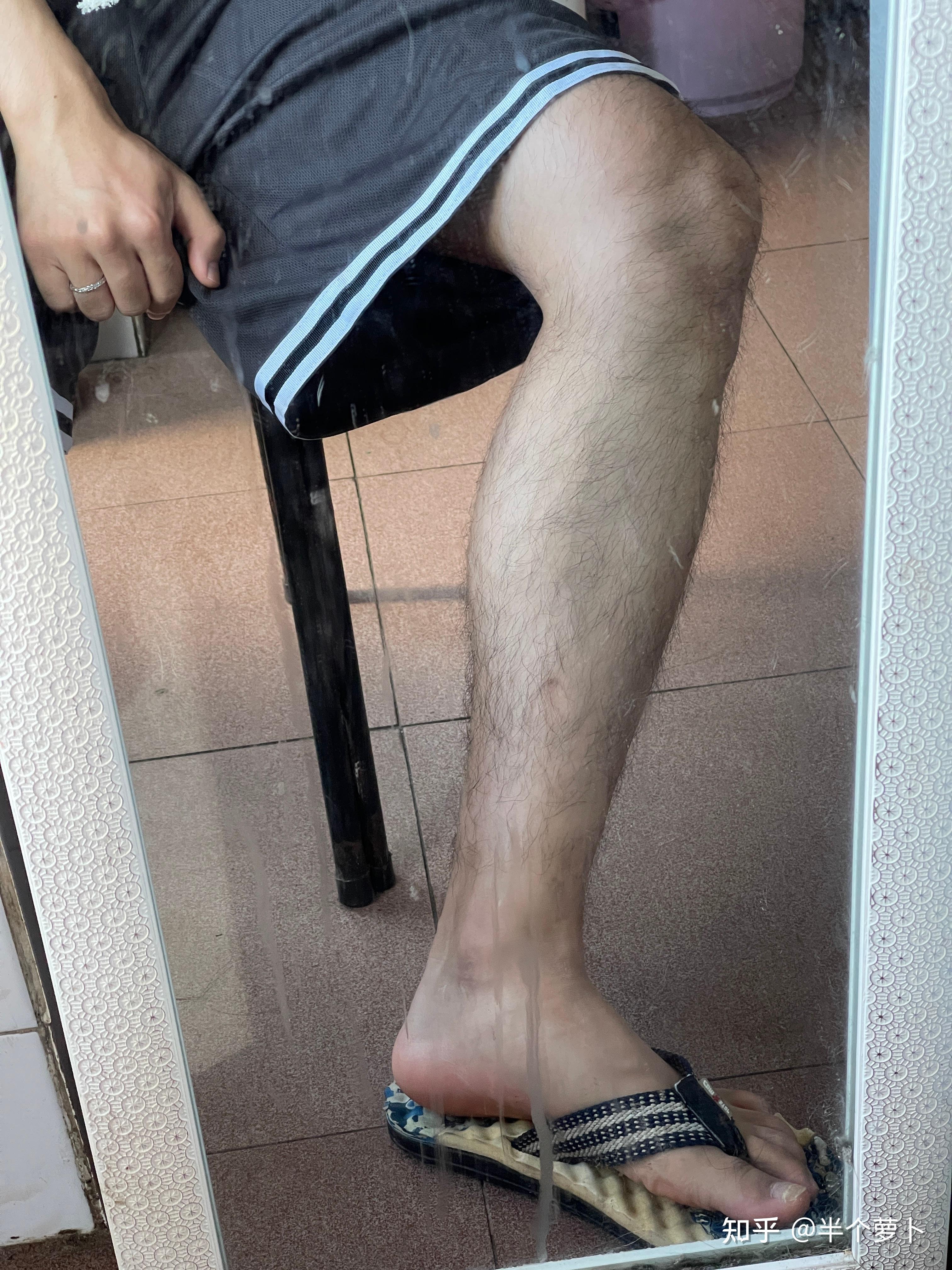 男生腿毛浓密怎么办