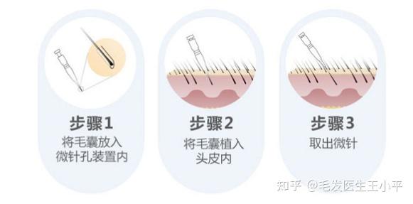 微针植发技术还有真假?真假微针如何辨别? - 知乎