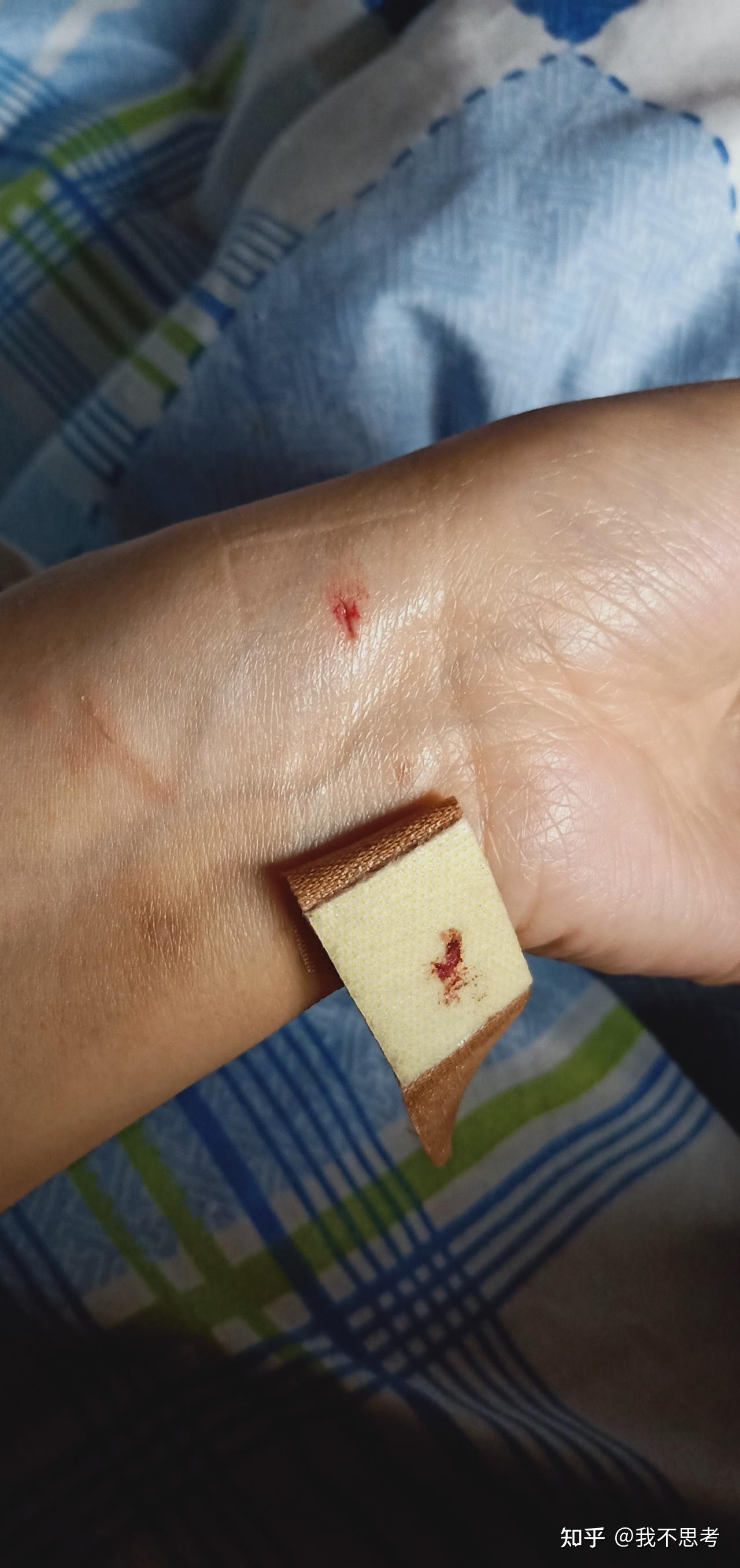 被家养猫咬出血需要害怕吗