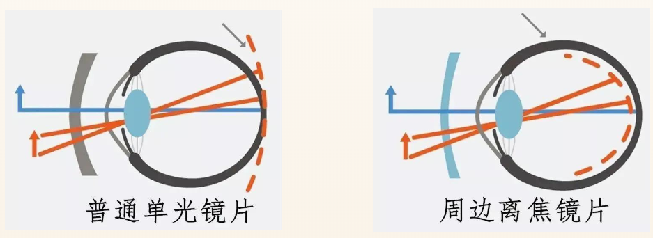 离焦镜是什么原理,真的可以缓解近视吗? - 知乎