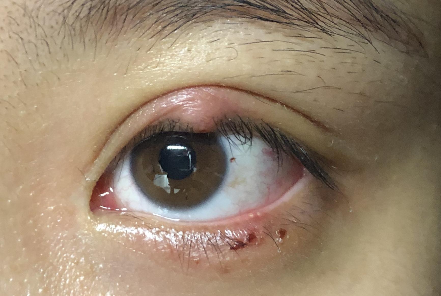 有没有得过外麦粒肿的朋友,怎么个痊愈过程? - 知乎