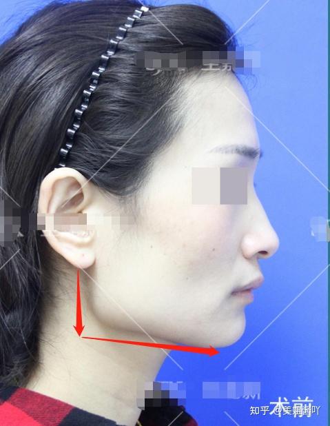 因为方脸脸宽下颌骨肥大而自卑怎么办该不该削骨