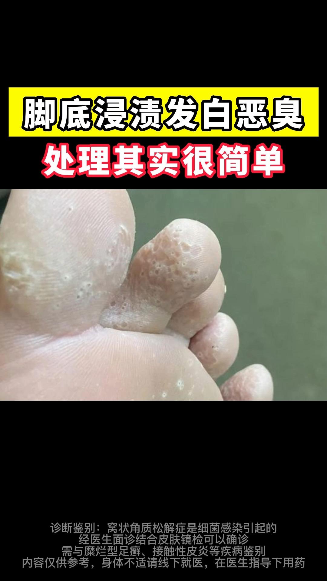 脚底浸渍发白恶臭处理其实很简单