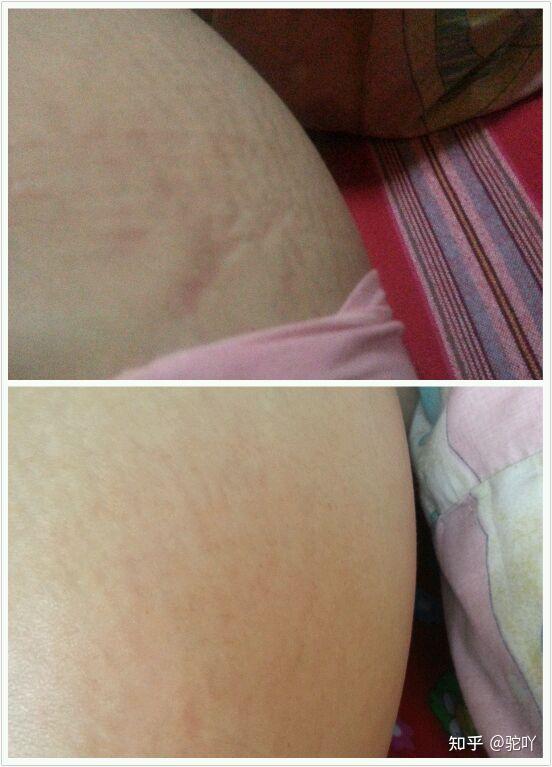 从怀孕到生完孩子,肚子上爬满了妊娠纹怎么办? - 知乎
