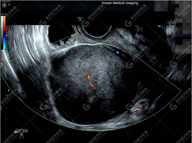 卵巢纤维瘤超声图片图片