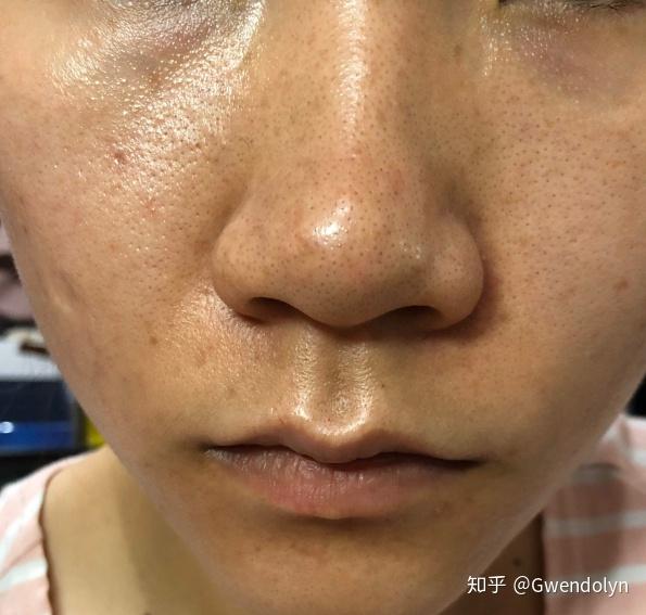 67 写回答 登录/注册 皮肤护理 皮肤 美容护肤 男生,脸上每天好多油