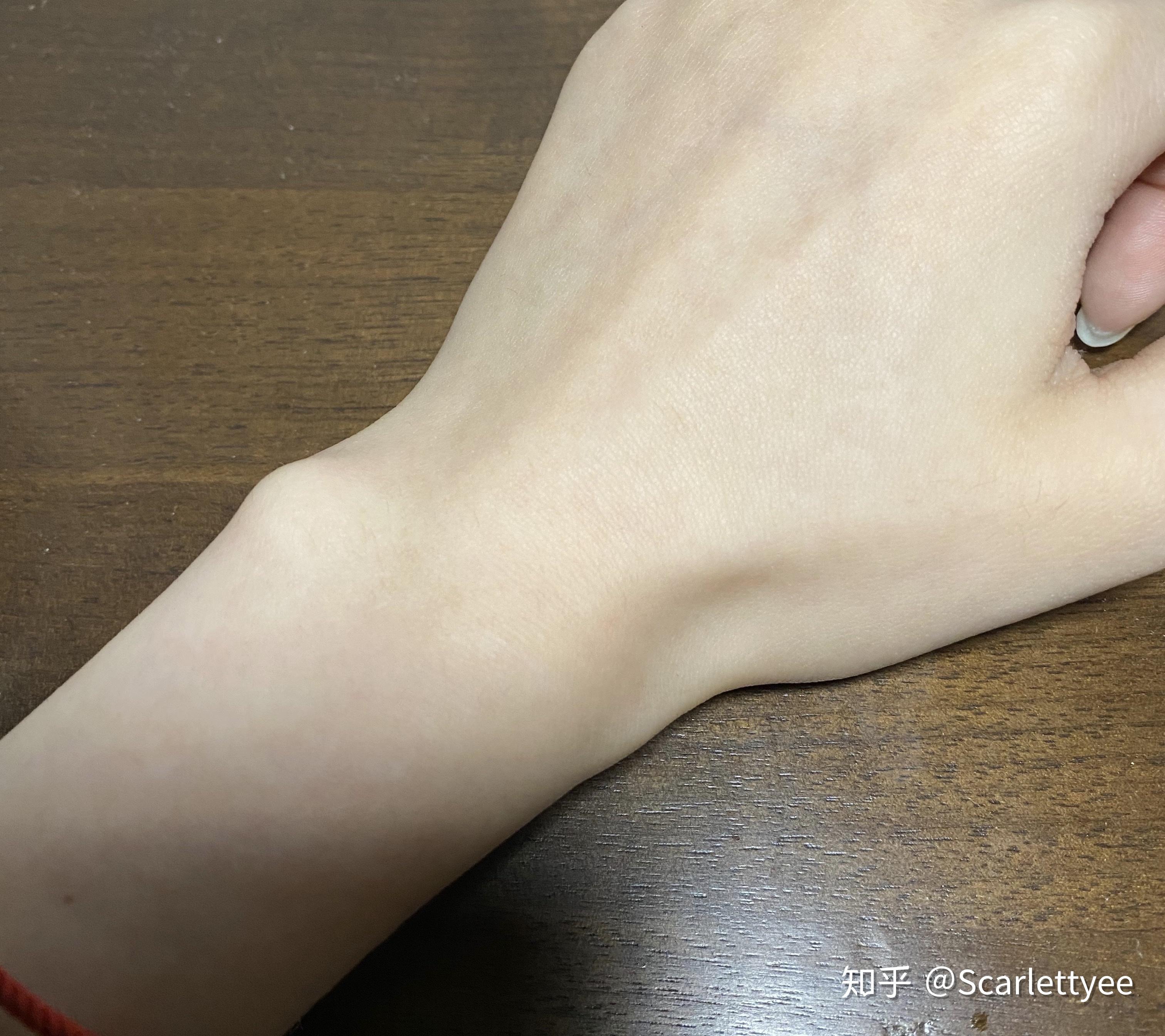为啥我的手腕处又块骨头突起啊是手腕外侧靠近小指而且左右手都有好久