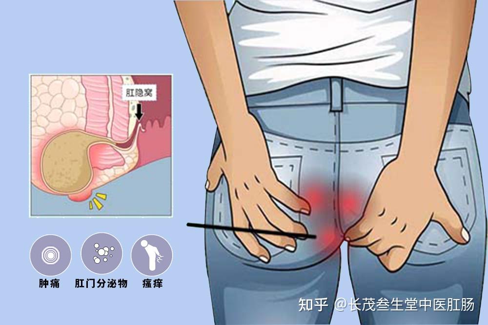 肛周脓肿有哪些自愈方法