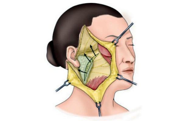 拉皮手术多大年龄做合适