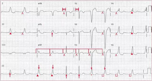 预激综合征心电图表现图片