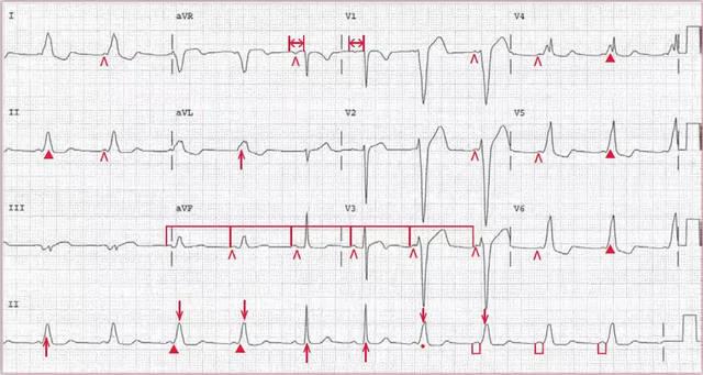 典型预激综合征的心电图分型
