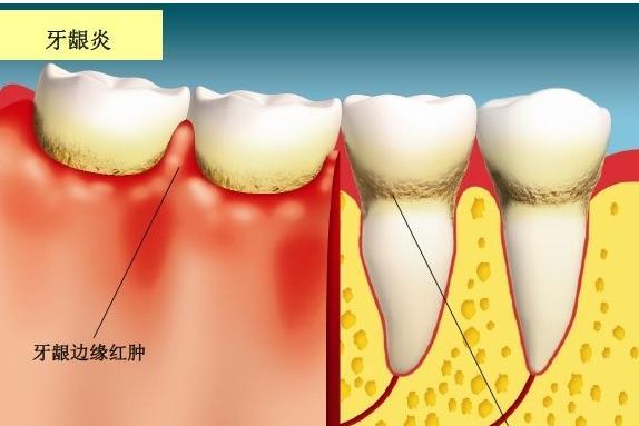 牙龈炎、牙周炎、牙髓炎，傻傻分不清？ - 知乎