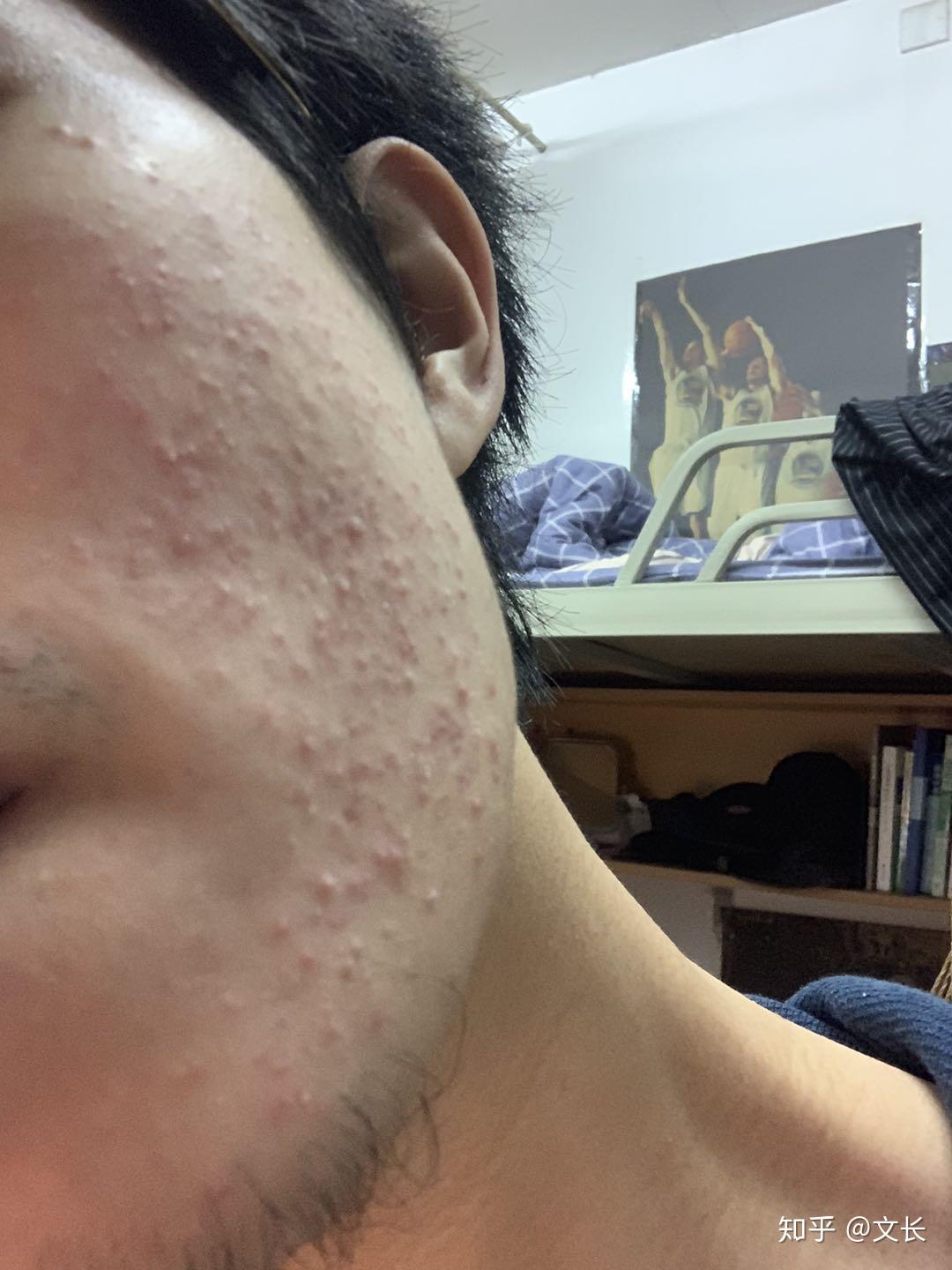 使用阿达帕林后,皮肤非常干燥脱皮,灼烧疼痛,而且脸特别红? - 知乎