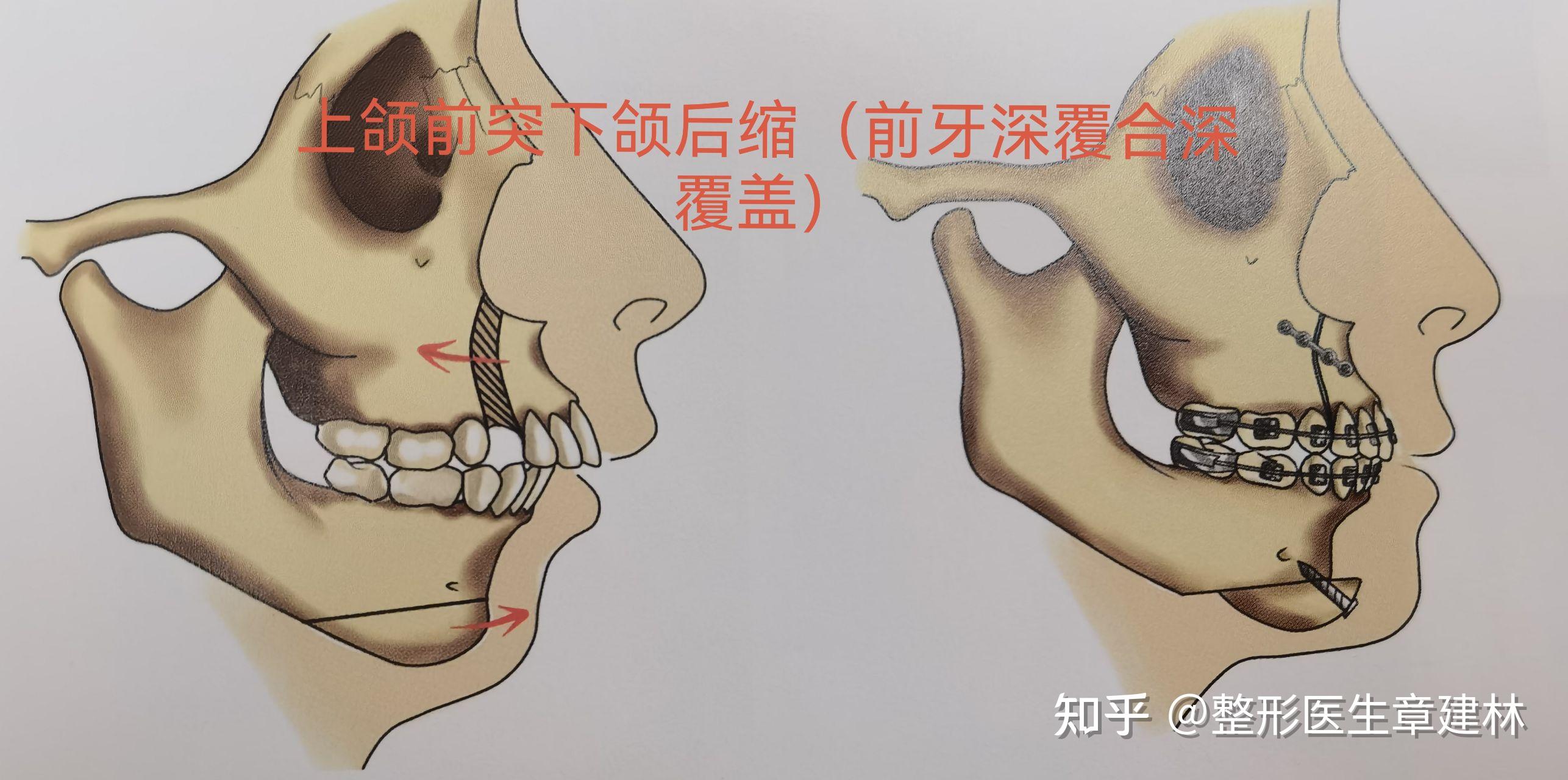 上颌前突能治愈么? - 知乎