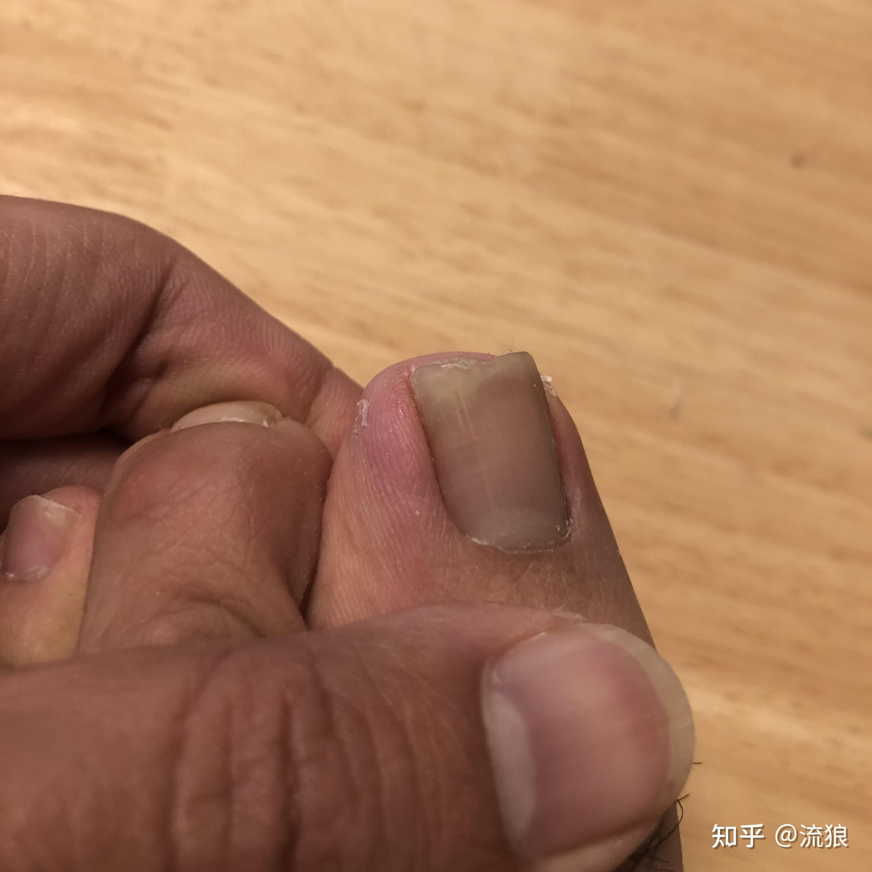 脚趾大拇指指甲两侧往肉里长怎么办啊