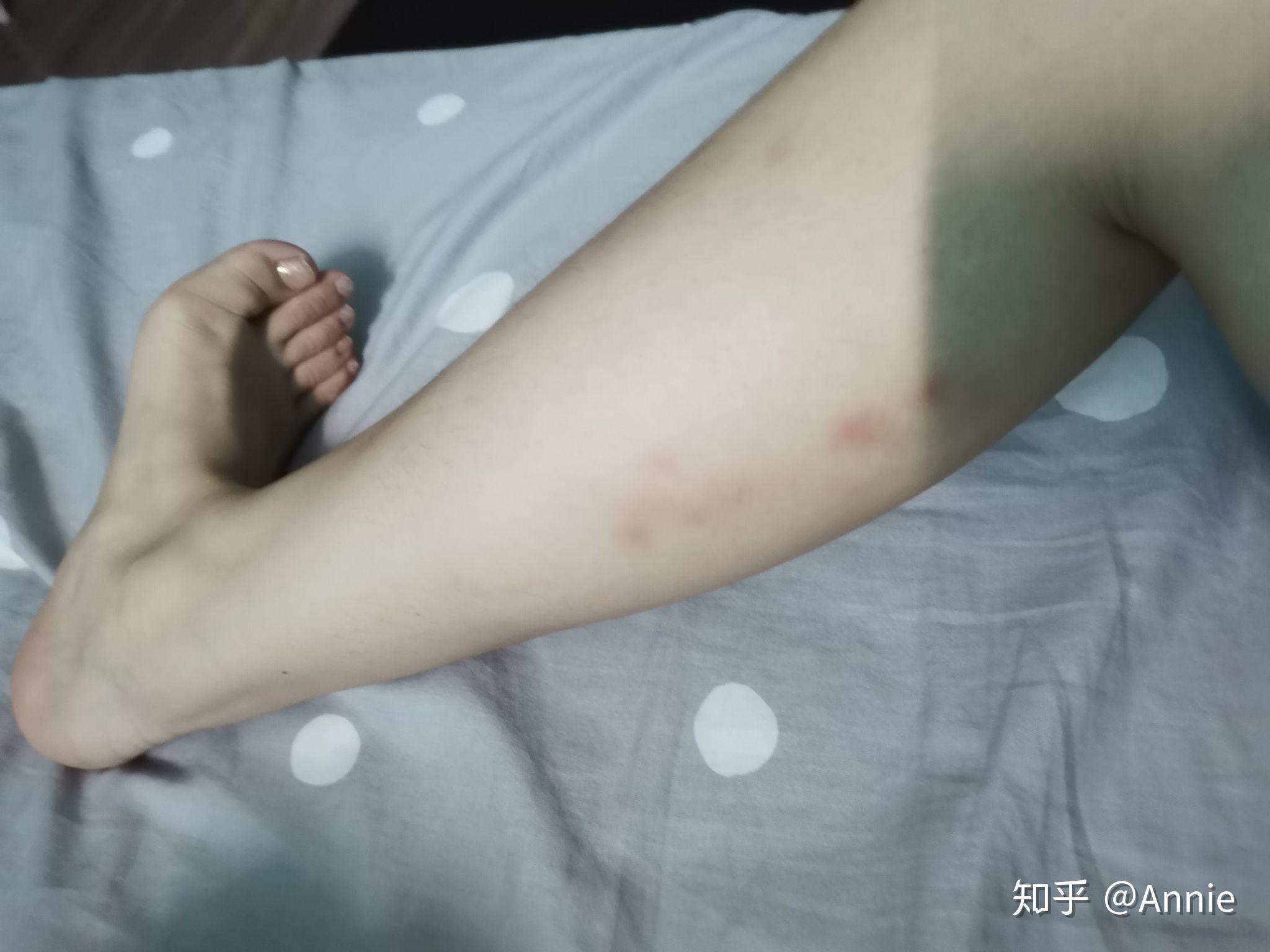 请问使用泡沫轴按摩大腿外侧时出现这样的淤青正常么使用大概半年了