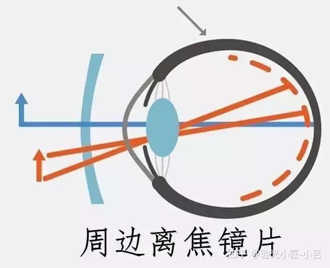 何为离焦型眼镜及适配人群? - 知乎