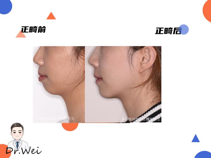 上海牙齿矫正丨嘴凸矫正,侧貌改变颜值提升 - 知乎