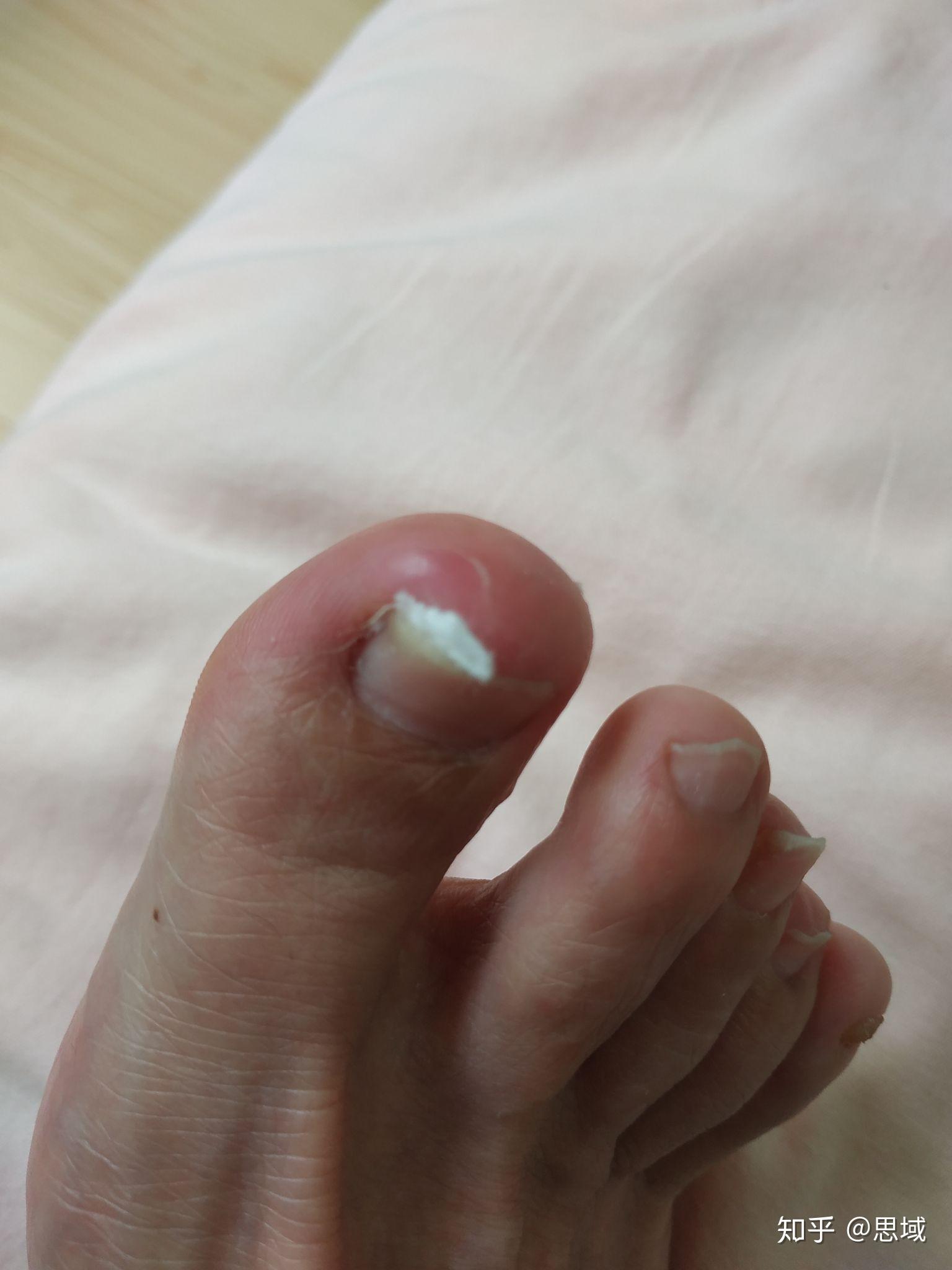 脚趾大拇指指甲两侧往肉里长怎么办啊?