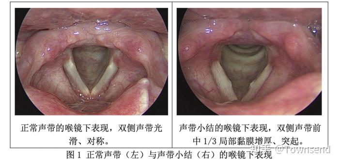 聲帶小結有哪些表現致病原因是什麼該如何預防和治療呢