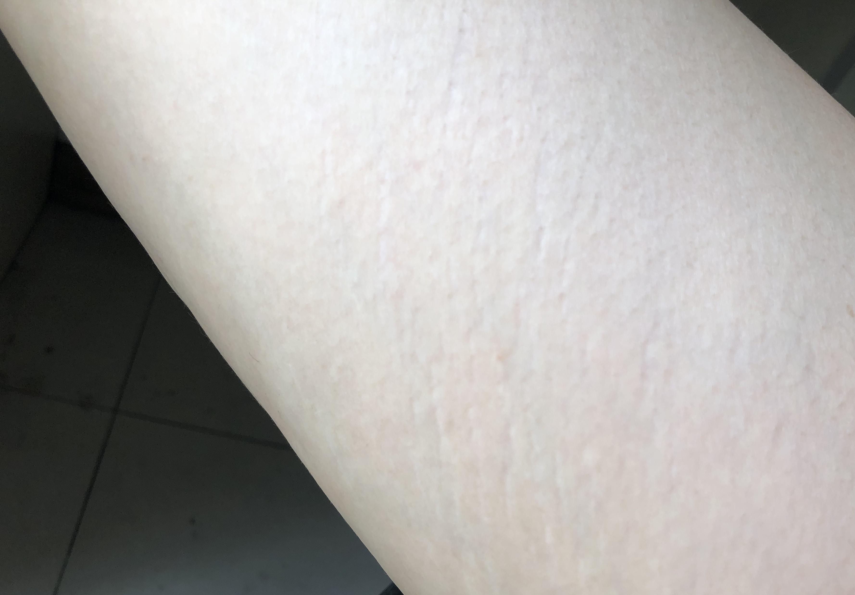 肥胖纹 瘦了会消失 嘛? - 知乎