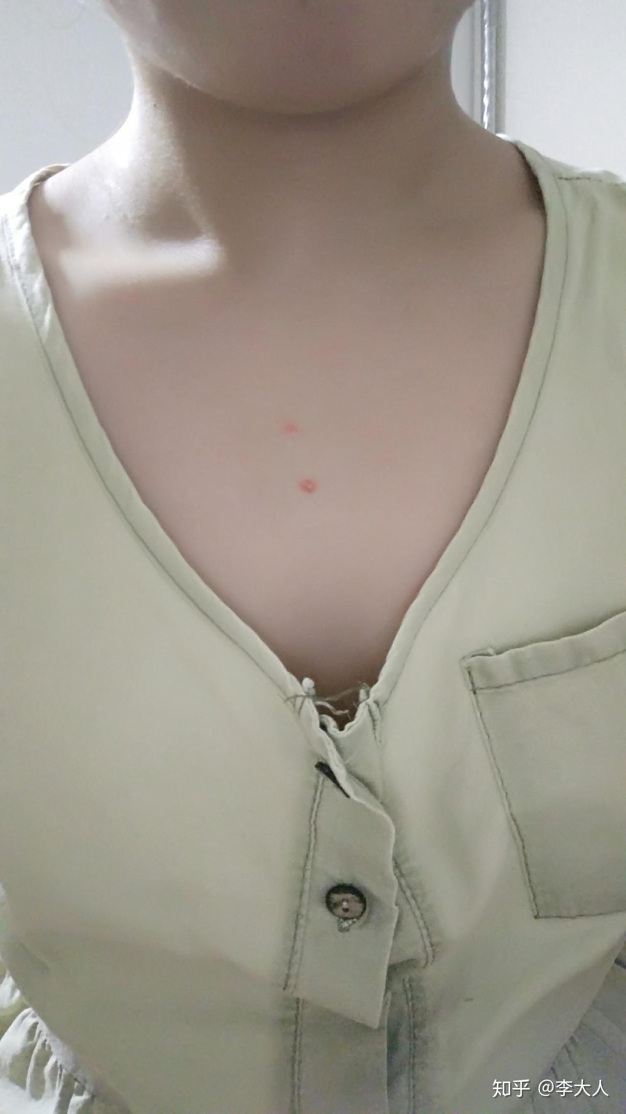 胸前长了一颗像痘一样的东西有六年了不痛不痒的硬硬的请问它是什么