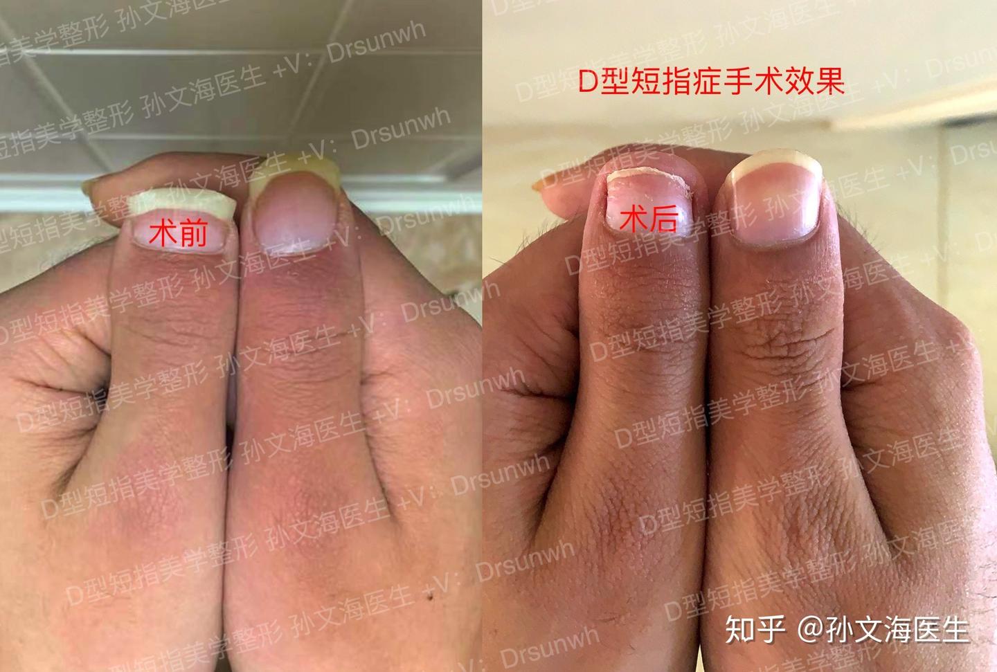 短指症d型