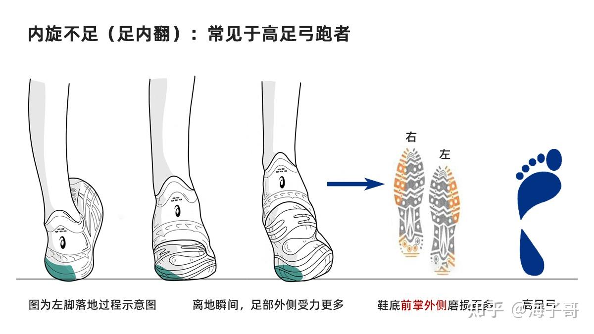一篇文章告诉你,怎么分辨足内翻和足外翻,高足弓还是低足弓? - 知乎