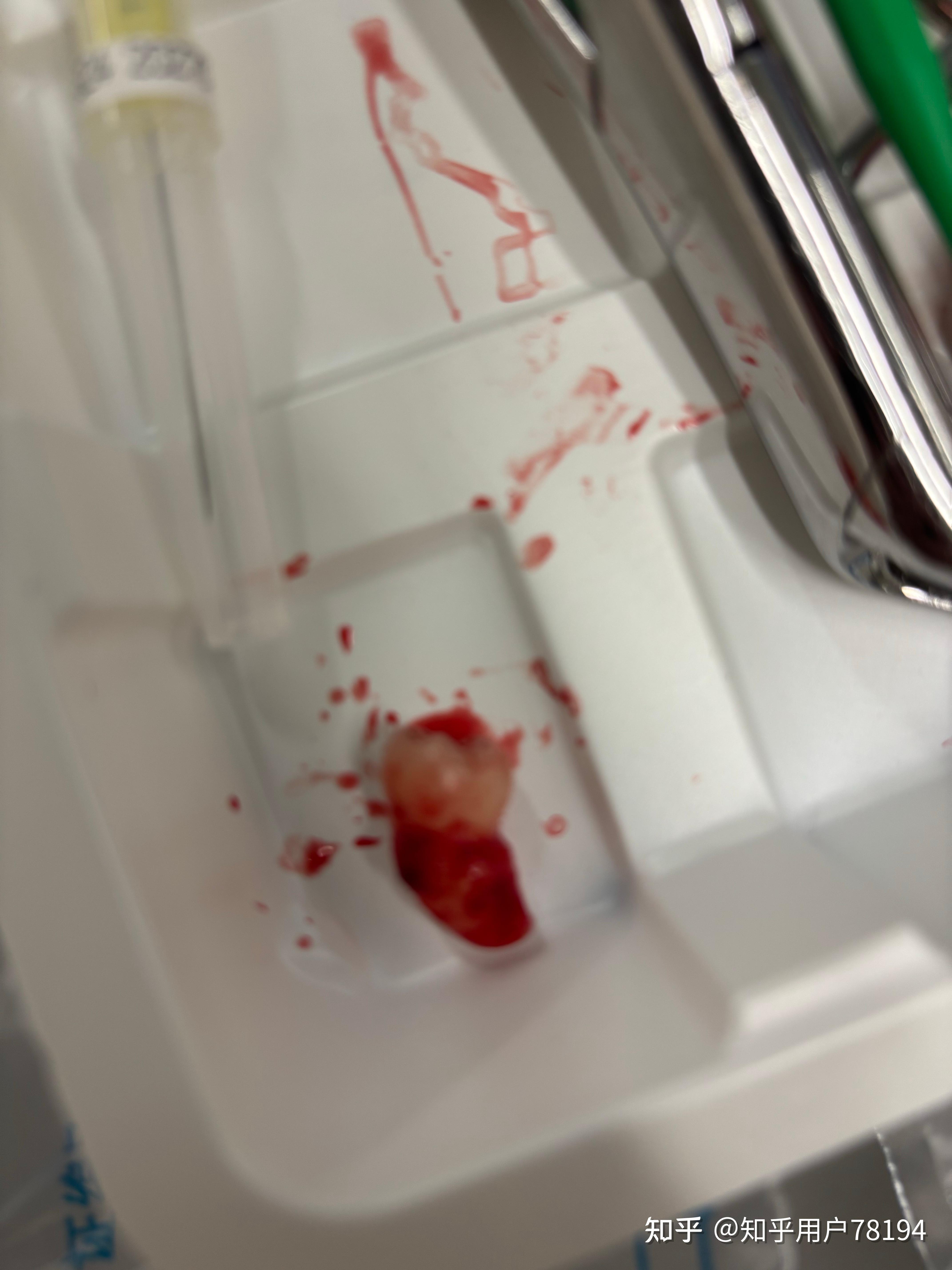 拔左下这种舌向智齿容易吗大家都是什么医院拔的费用大概多少