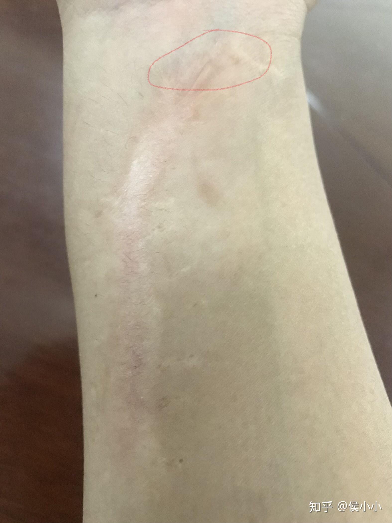 你的身上有哪些形状奇特的伤疤? - 知乎