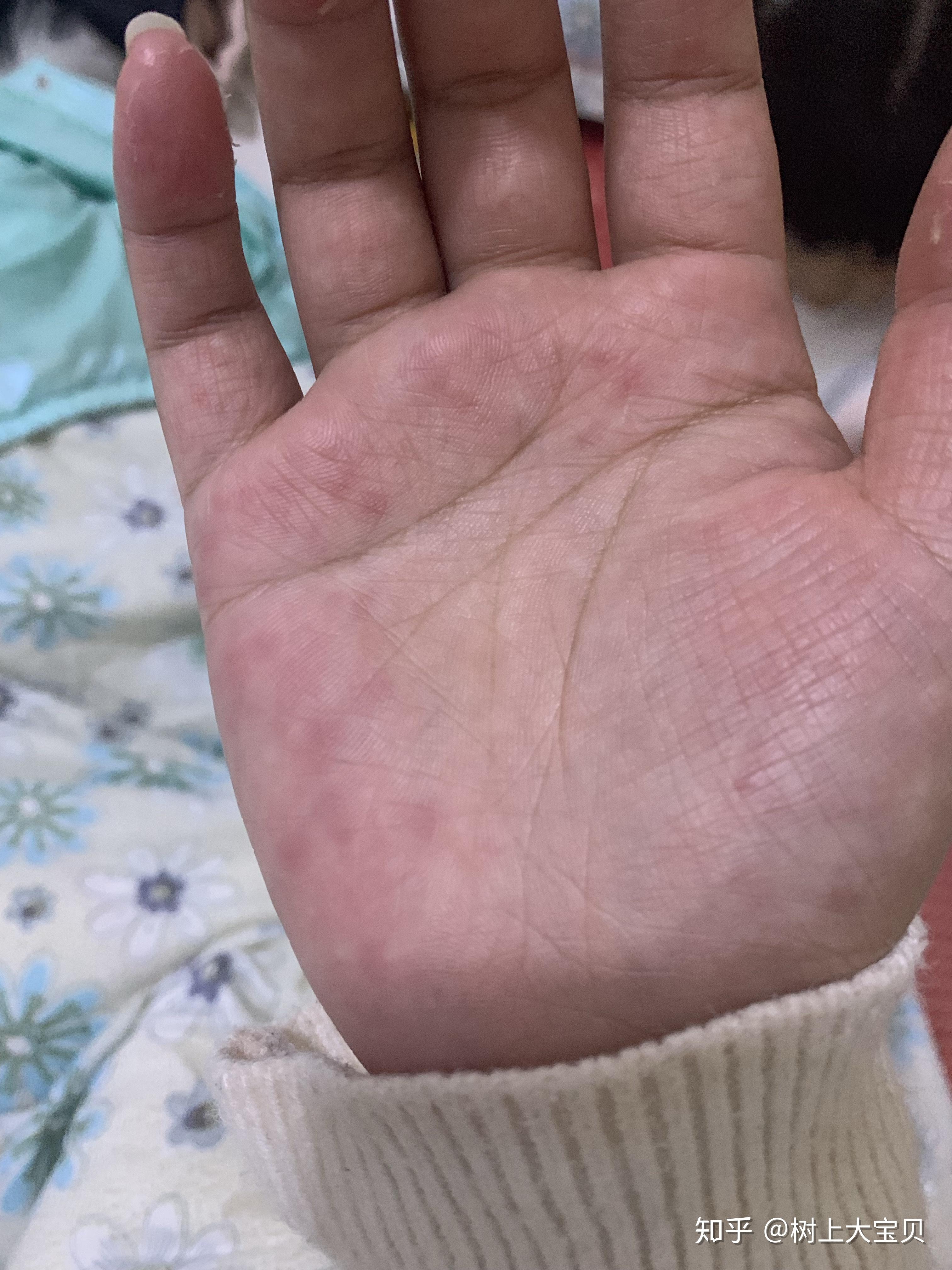 有对洗衣粉洗衣液过敏的人吗