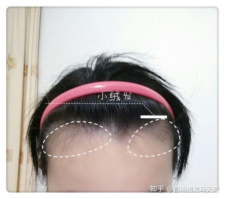 天生大额头且鬓角秃,想去植发,想问一下我这种情况大概需要多少钱呐?