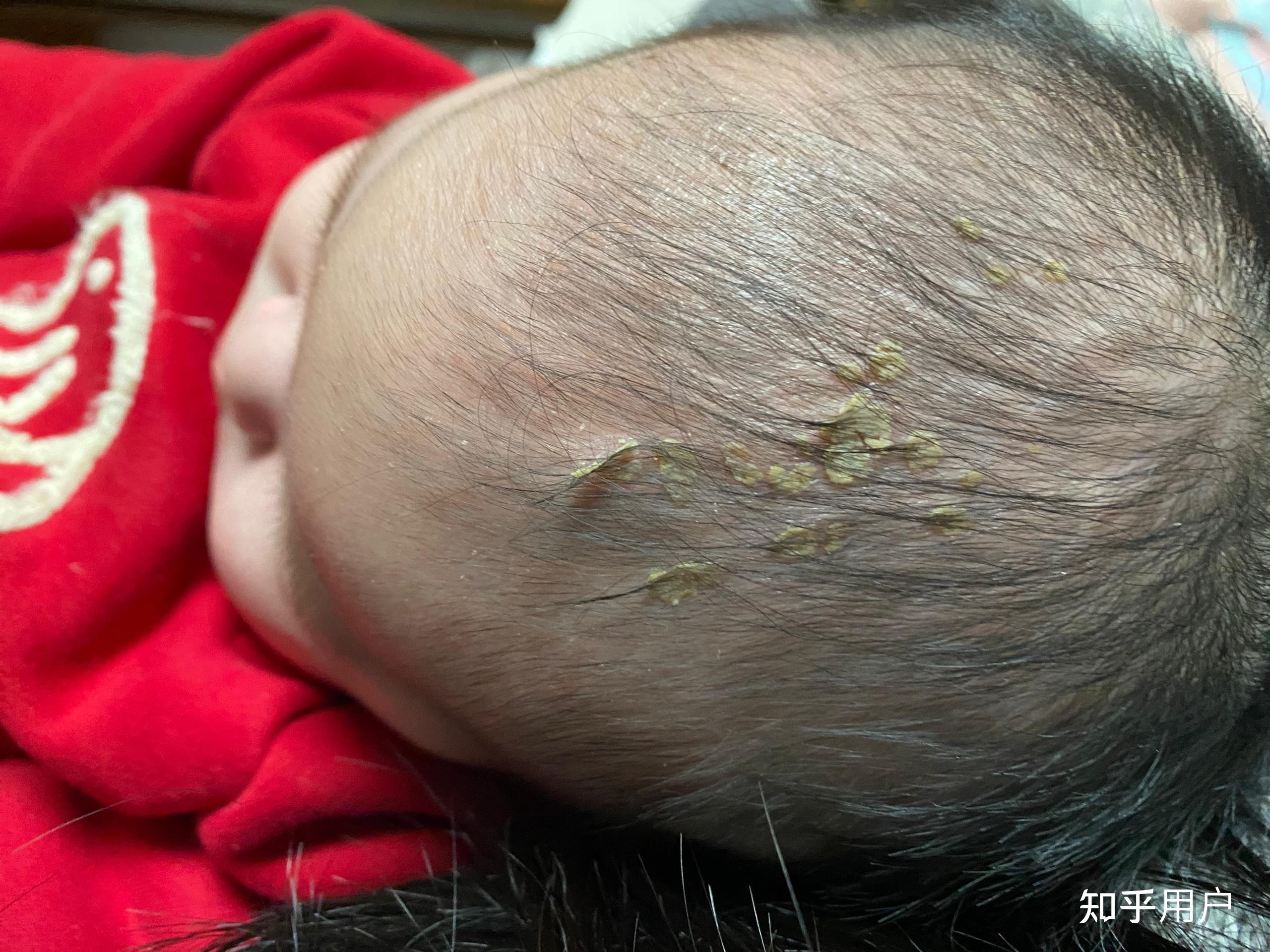 如何去除新生儿头皮上的乳痂? - 知乎
