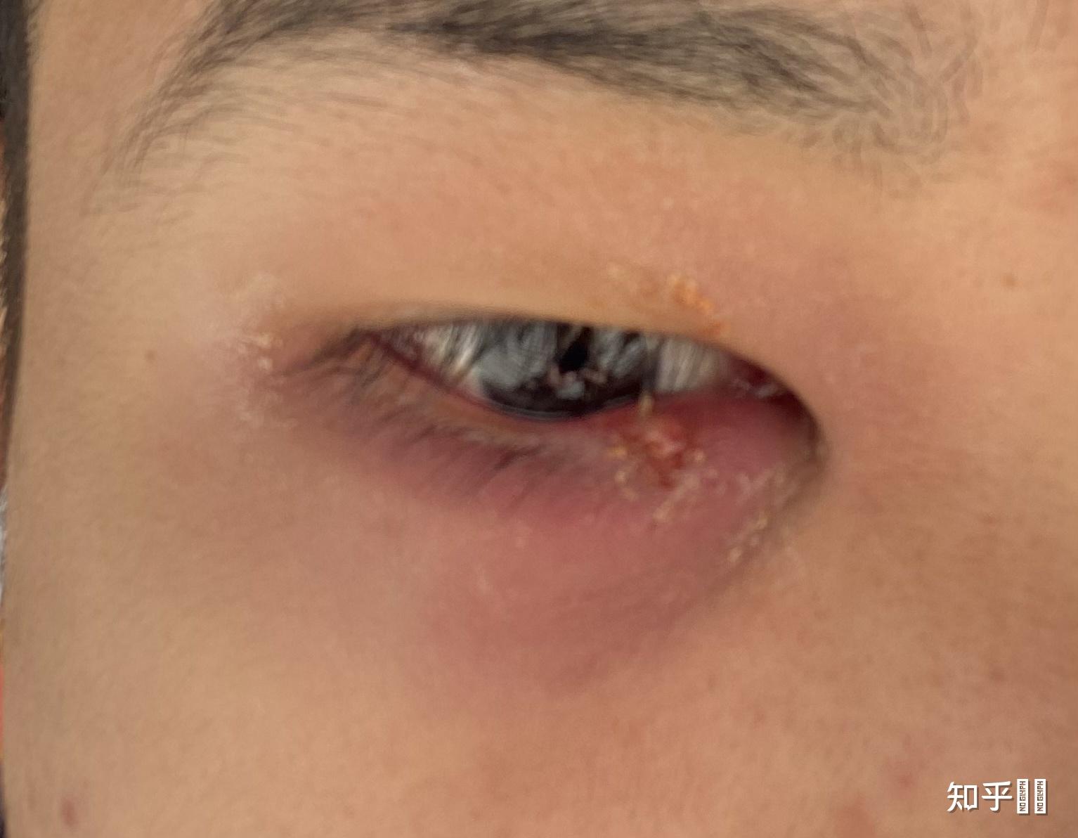 生了撅眼怎么办