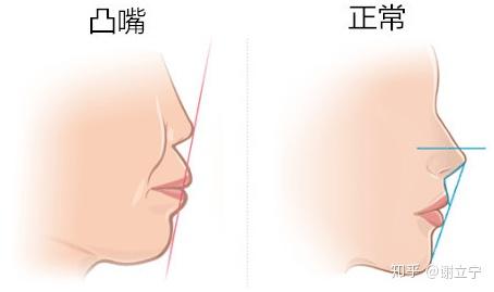  平凸雙凸凹凸翼型_平凸與雙凸透鏡的用處