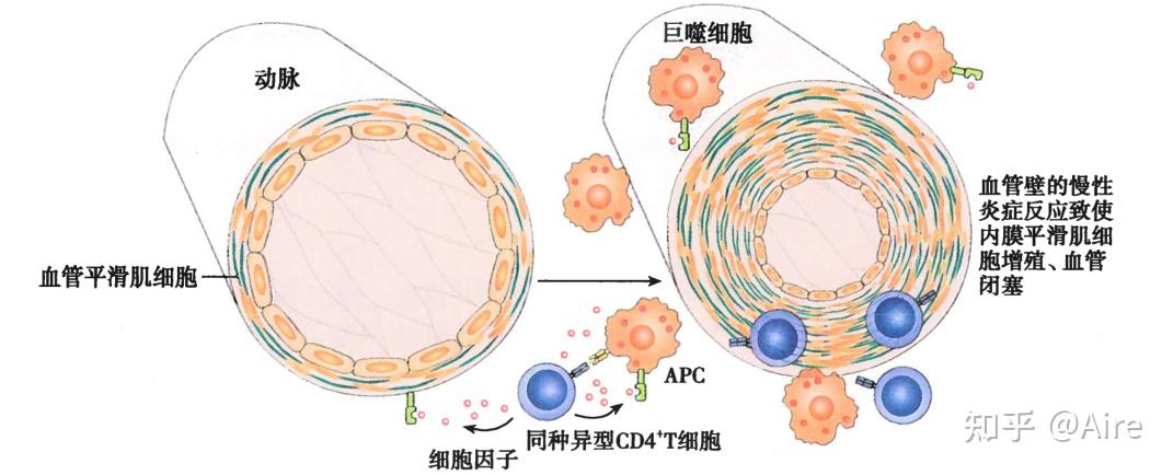 排斥反應是細胞免疫還是體液免疫