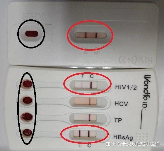 艾滋病弱阳图片图片