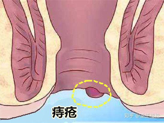 分别痔疮还是肛裂