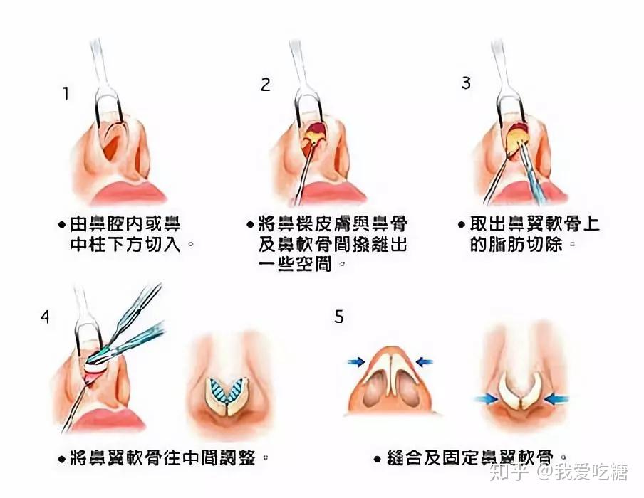 鼻翼软骨缝合是永久的么