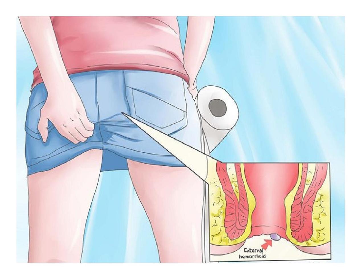「痔疮」是一种怎样的疾病? - 知乎