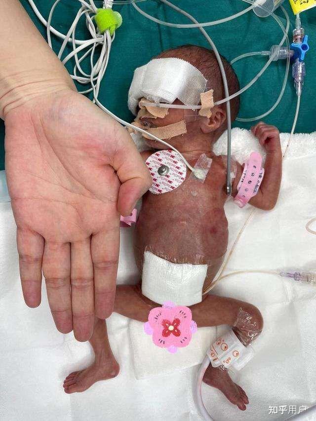 老婆早产才26周出生时700克产儿可以健康成长吗