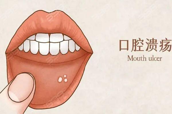 口腔溃疡害怕的3种水果，口腔溃疡可千万得忌口 - 知乎