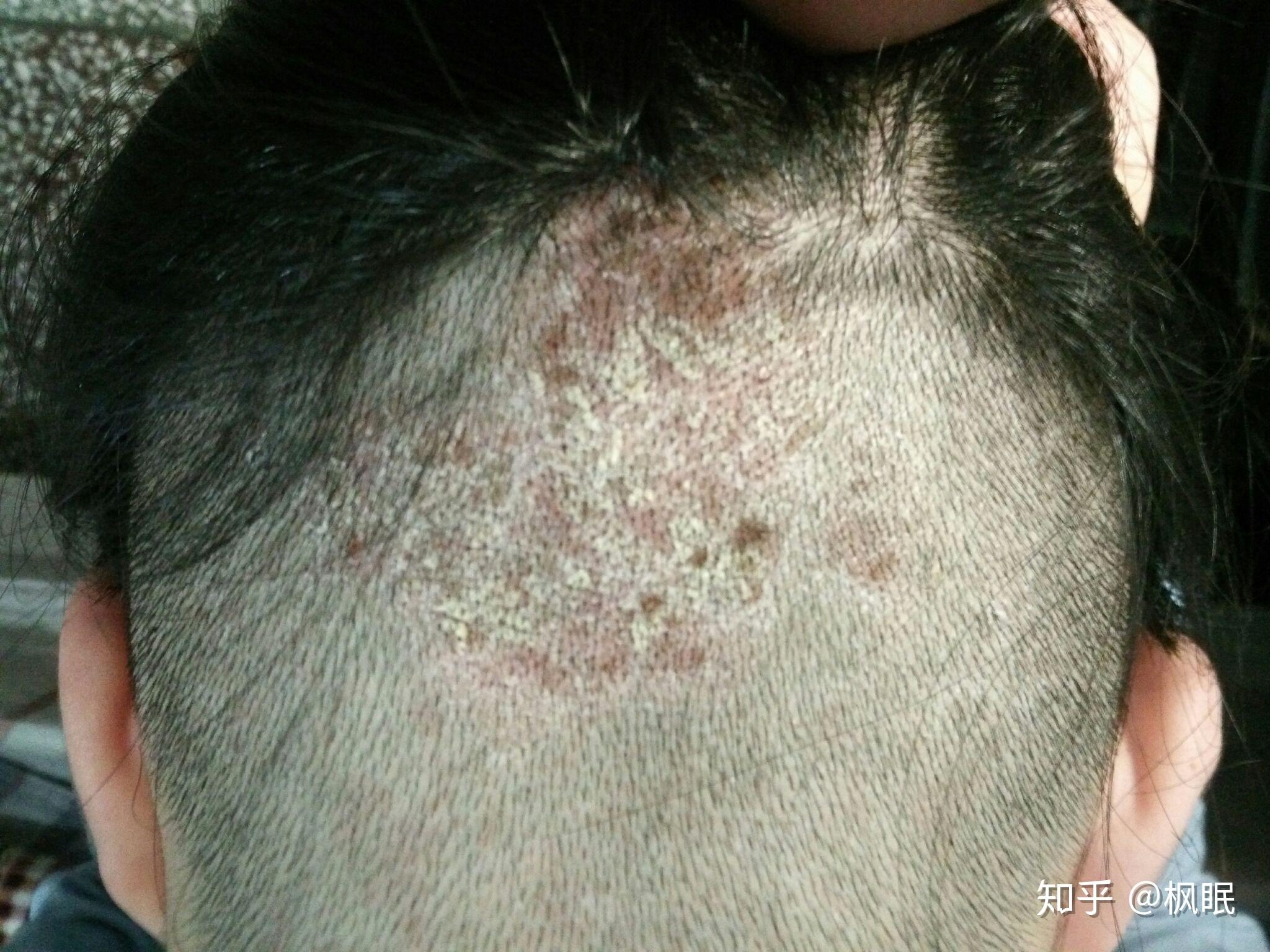 头部脂溢性皮炎的治愈过程? - 知乎