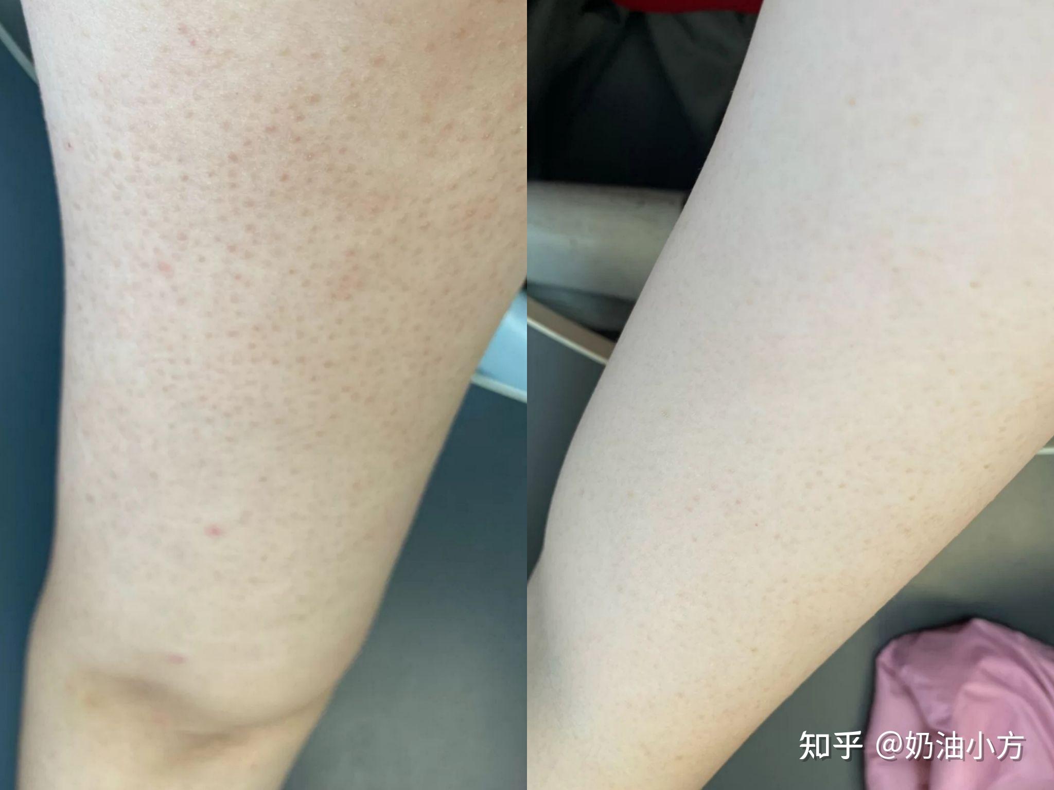 女友有鸡皮肤要分手(女朋友有鸡皮肤很介意怎么办)