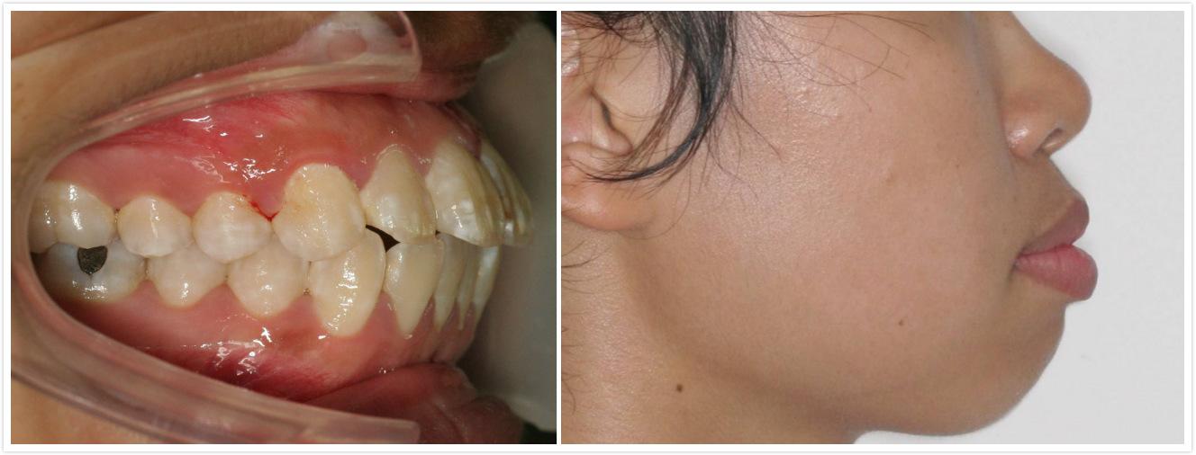 我这算骨性龅牙吗?