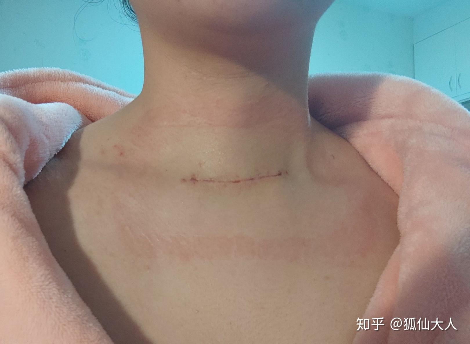 甲状腺术后疤痕增生,用什么祛疤膏好一些? - 知乎