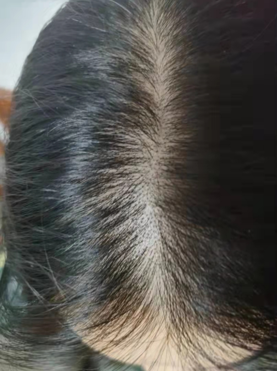 脂溢性脱发的表现是什么？