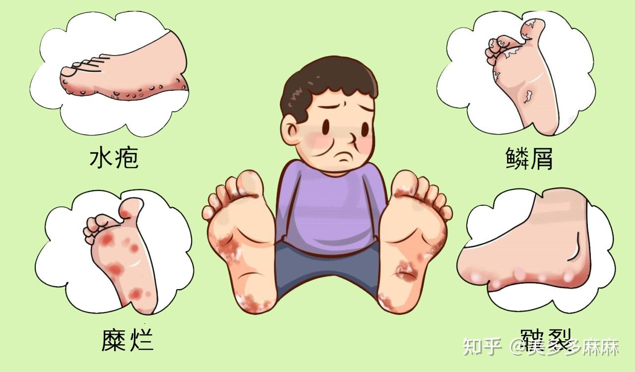 脚气真的治不好吗? - 知乎