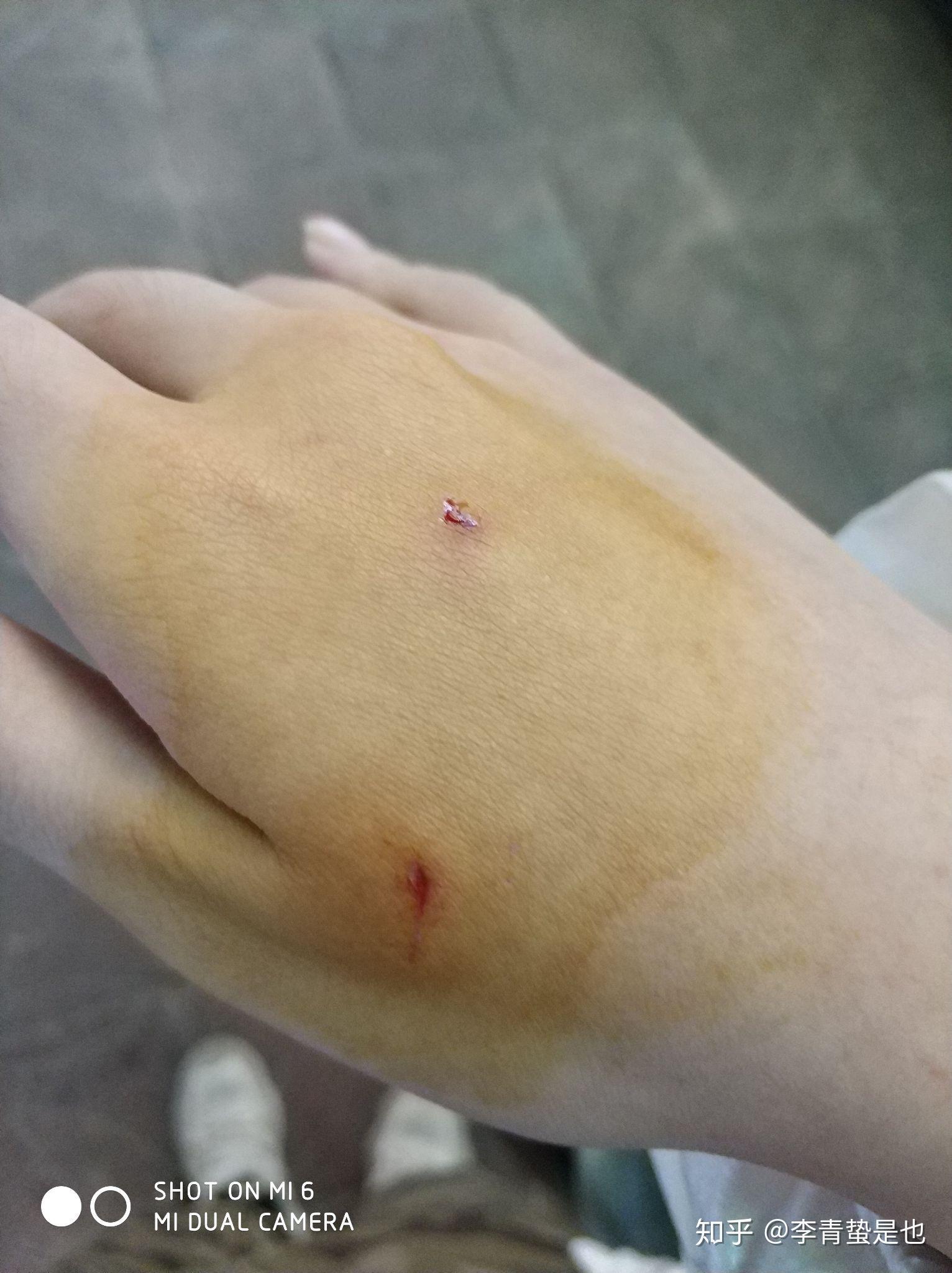 手指被猫咬了一个小眼出血了可以不打针吗